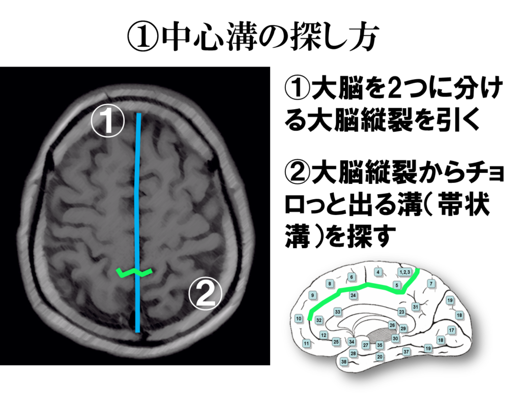 脳画像から一次体性感覚野（3,1,2野）を探す方法とは？