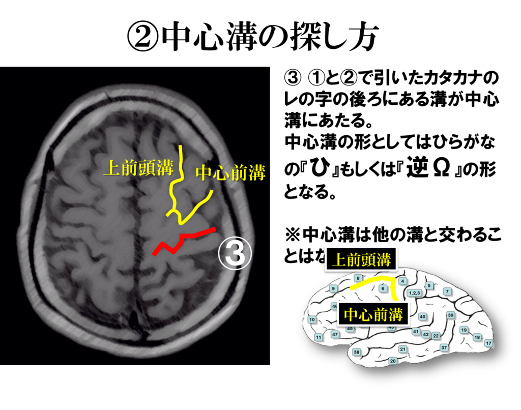 脳画像から一次運動野を探す方法とは 運動麻痺の評価の最初の一歩 リハアイデア