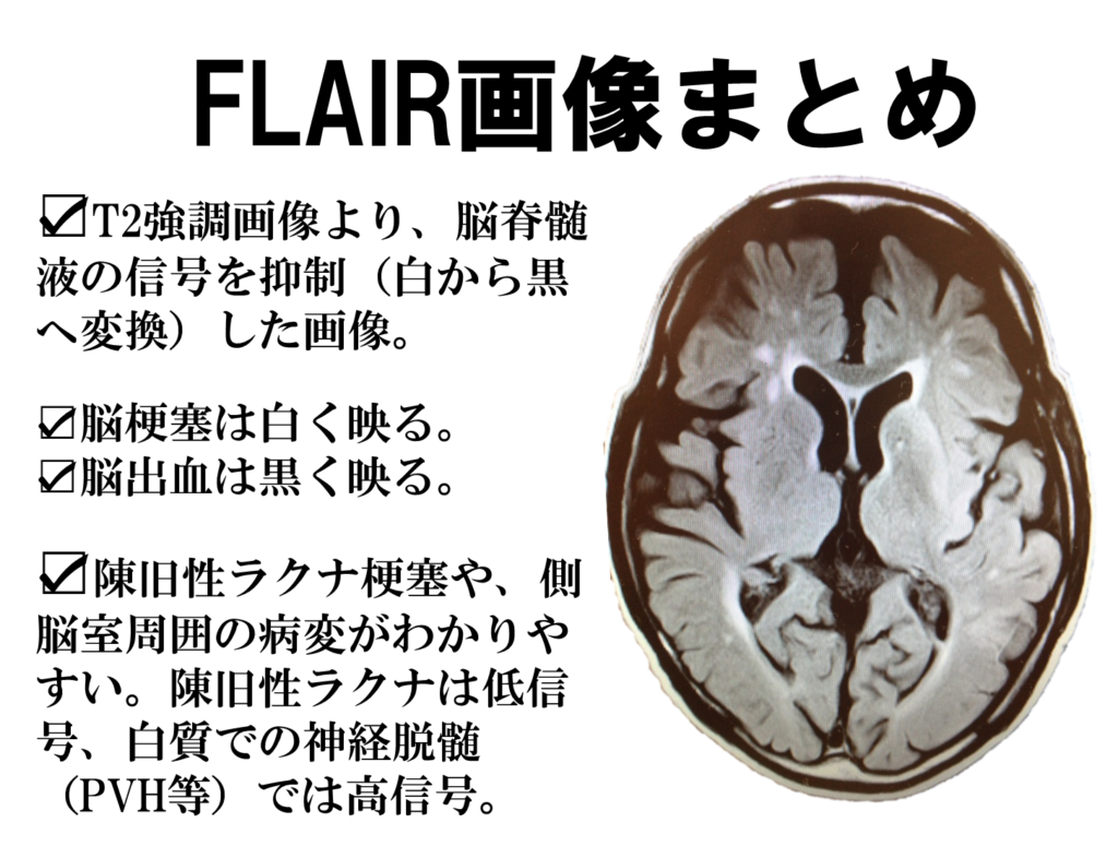 脳画像におけるct Mriの見方 みるべきポイントさえ押さえれば 脳画像は簡単に見れる リハアイデア