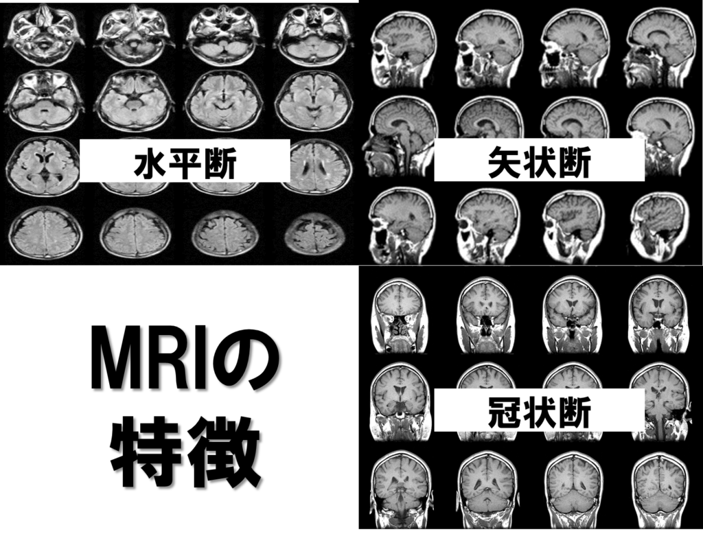 脳画像におけるct Mriの見方 みるべきポイントさえ押さえれば 脳画像は簡単に見れる リハアイデア