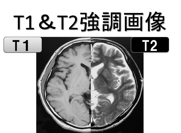 灰白質と白質に影響を与える病気は何ですか?