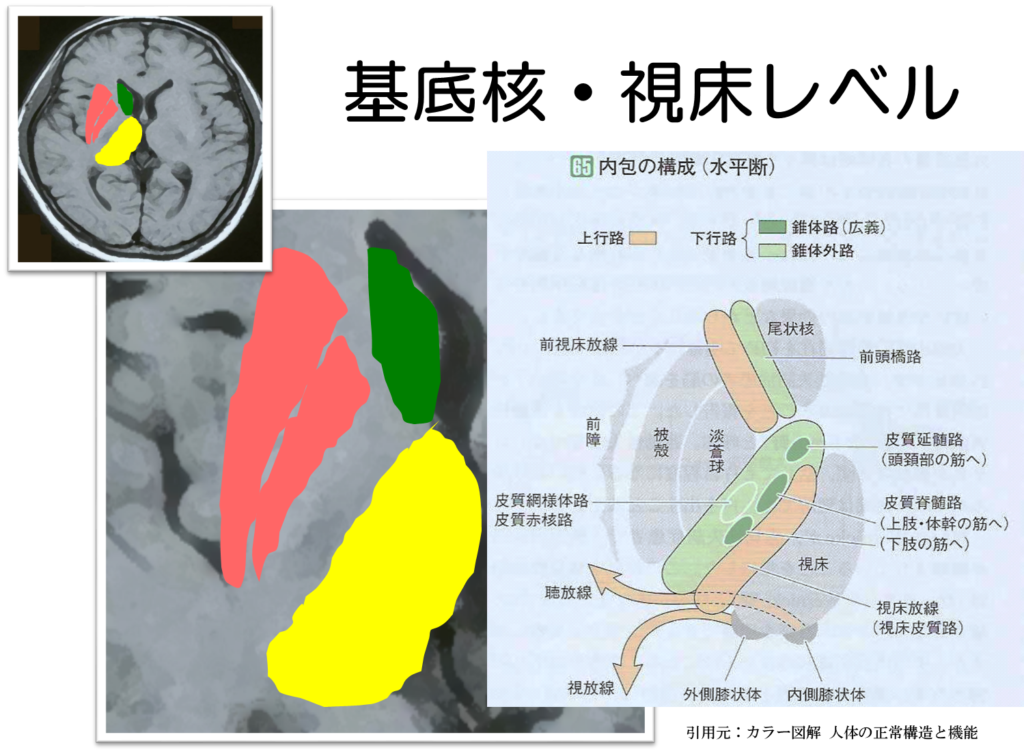 皮質脊髄路 錐体路 を脳画像から簡単に見つける方法 運動麻痺を理解する5つの見るべきポイントとは リハアイデア