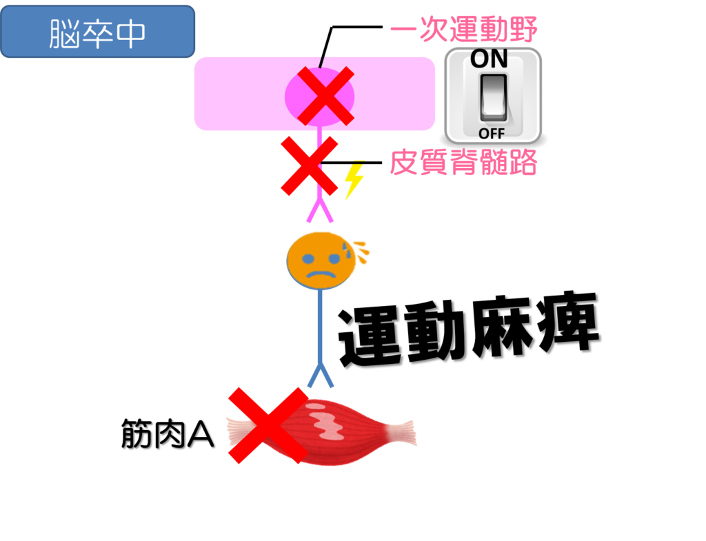 運動麻痺の種類や評価は 運動麻痺のメカニズムから紐解くリハビリの工夫 リハアイデア