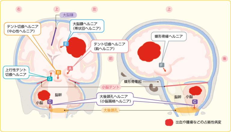 脳ヘルニアの原因