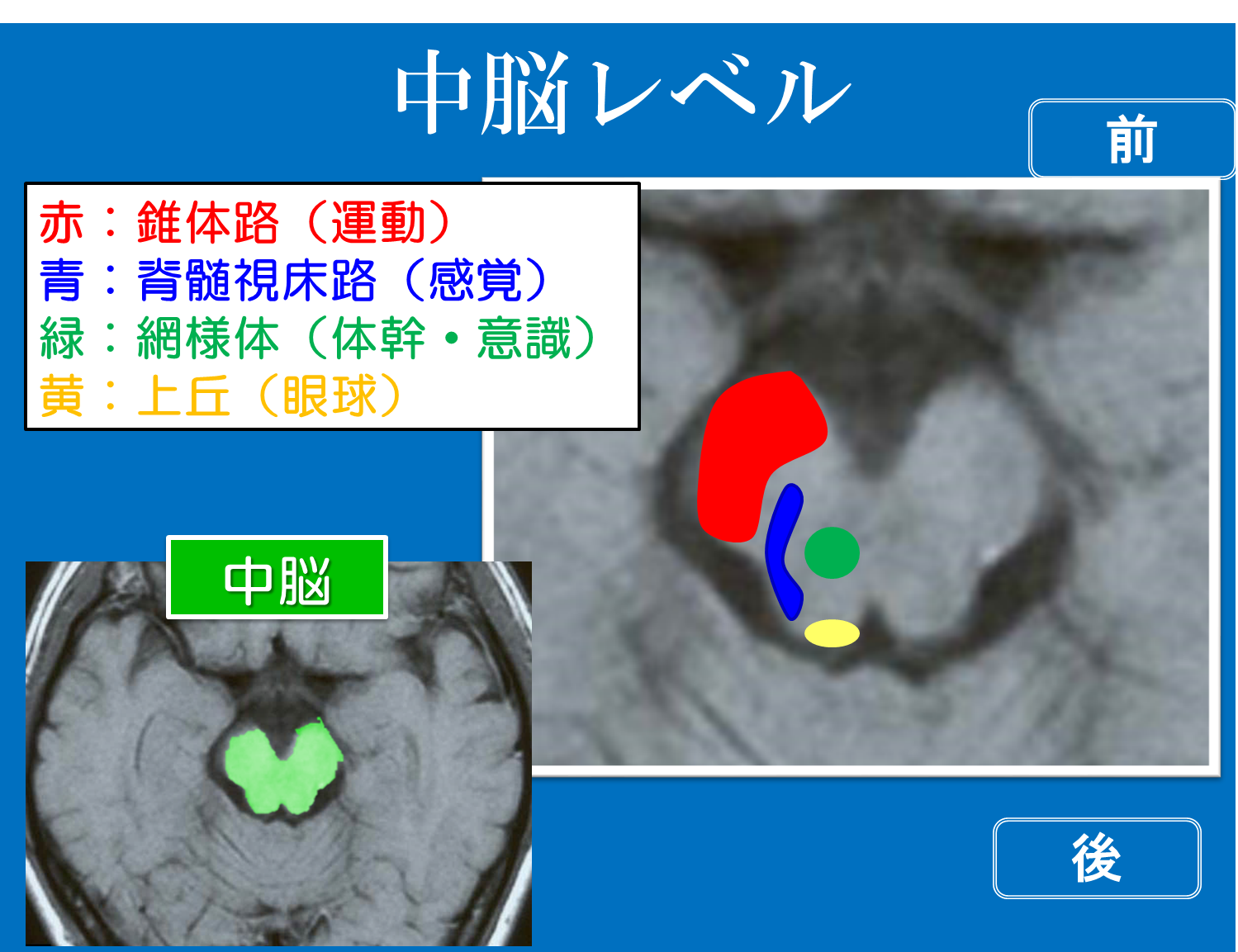 理学療法士・作業療法士の国家試験で絶対覚えておいてほしい脳画像をみるポイント! | リハアイデア