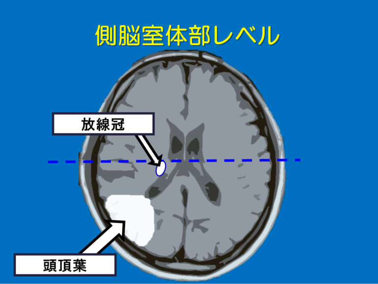 理学療法士・作業療法士の国家試験で絶対覚えておいてほしい脳画像をみるポイント！ | リハアイデア