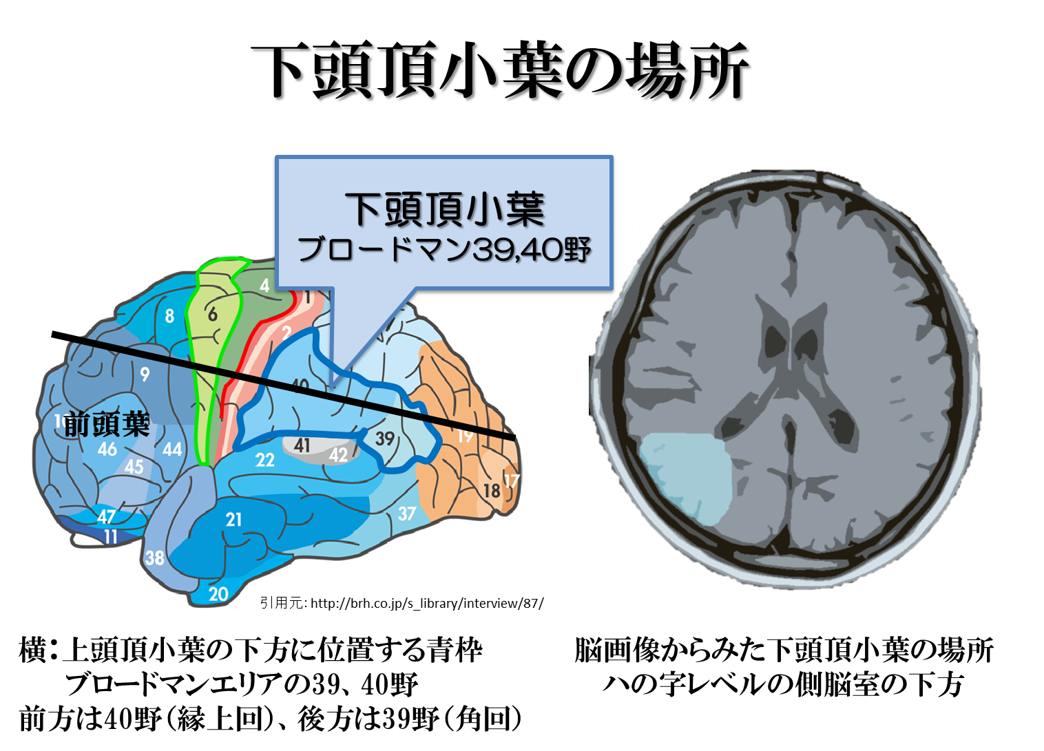 半側空間無視が出現する脳障害部位とは！？責任病巣は頭頂葉だけではなかった！ リハアイデア